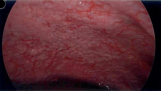 Laparoscopy—peritoneal disease in left upper quadrant.