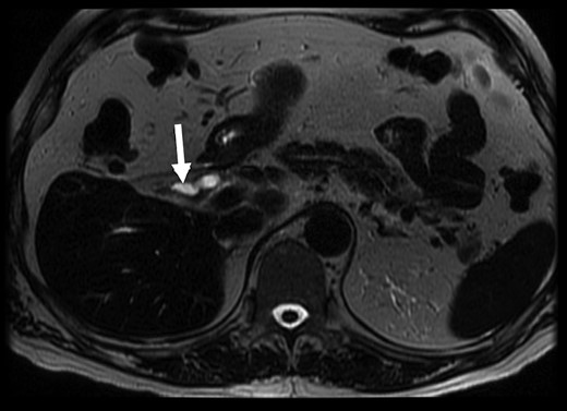 MRCP with suggestion of gallbladder adjacent to CBD (arrow). T2 weighted axial MRCP image, 3.0 T GE MRI.