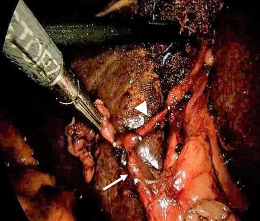 Calot’s triangle—intra-operative photograph showing cystic duct (arrow) and cystic artery (arrowhead).