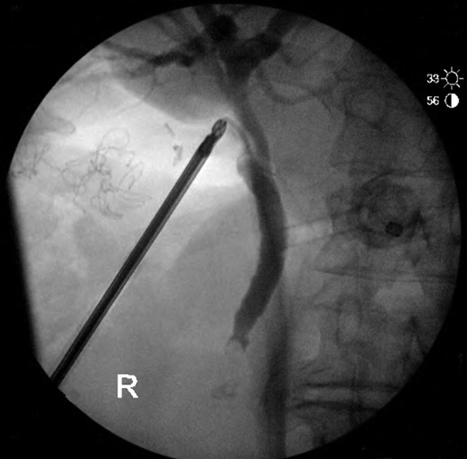 Intra-operative cholangiogram with filling defect in distal CBD.