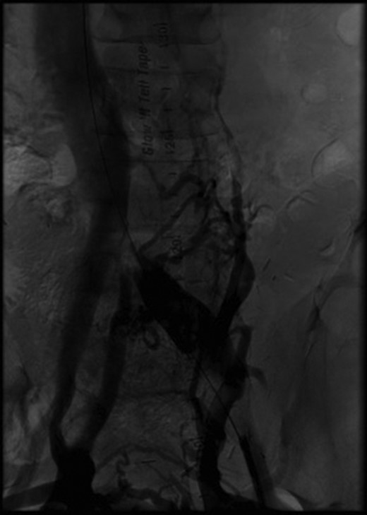 Initial angiography demonstrating thrombus in left common iliac vein with surrounding collaterals.