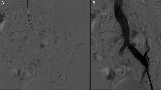 (A) Stent placement (B) Angiography post-thrombectomy and stent showing intact runoff to pancreatic and renal allografts (arrows).