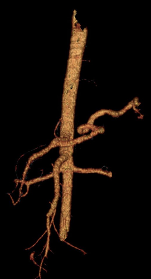 TAC reconstruction of hepatic artery avulsion.