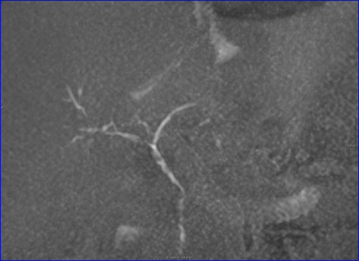 MRI: biliary tract, multiple stenosis. ischemic cholangiopathy.