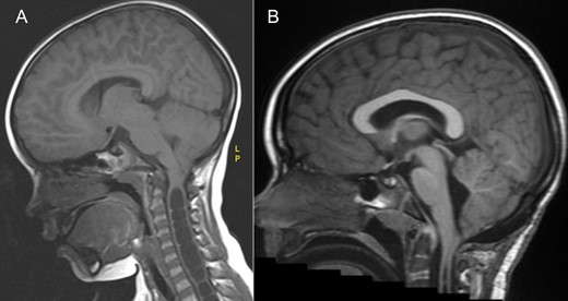 MRI brain demonstrating the chiari 1 malformation. Pre-op sagittal T1 showing cerebellar tonsillar descent of 9 mm below the foramen magnum (A) and at 3 years post op showing adequate hind brain decompression (B).