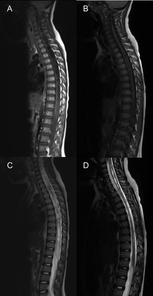 MRI spine sagittal sections demonstrating a holocord syrinx decreasing in size following surgery. Pre (A) and 3 years post op (B) T2. Pre (C) and 3 years post op (D) and T1.