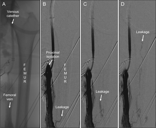 (A) Overview showing femur, the femoral vein and the venous catheter in place. (B) First venography showing the site of proximal isolation and leakage through the medullary vein in femur (arrow). (C) Successive image with proximal direction of leakage flow within the femur (arrow). (D) Continuous leakage through bone marrow up to femoral head (arrow).