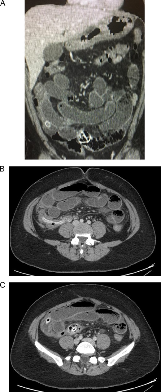 (A) Contrast-enhanced abdominal CT: intestinal loops are dilated. (B) Contrast-enhanced abdominal CT: a metallic foreign body is seen in the ileum. (C) Contrast-enhanced abdominal CT: showing clear signs of bowel obstruction.