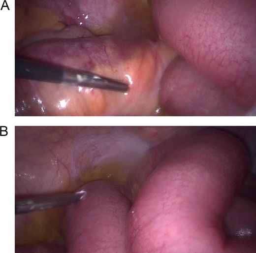 (A) Laparoscopy, showing dilated intestinal loops. (B) Laparoscopy, showing dilated intestinal loops and free inflammatory fluid.