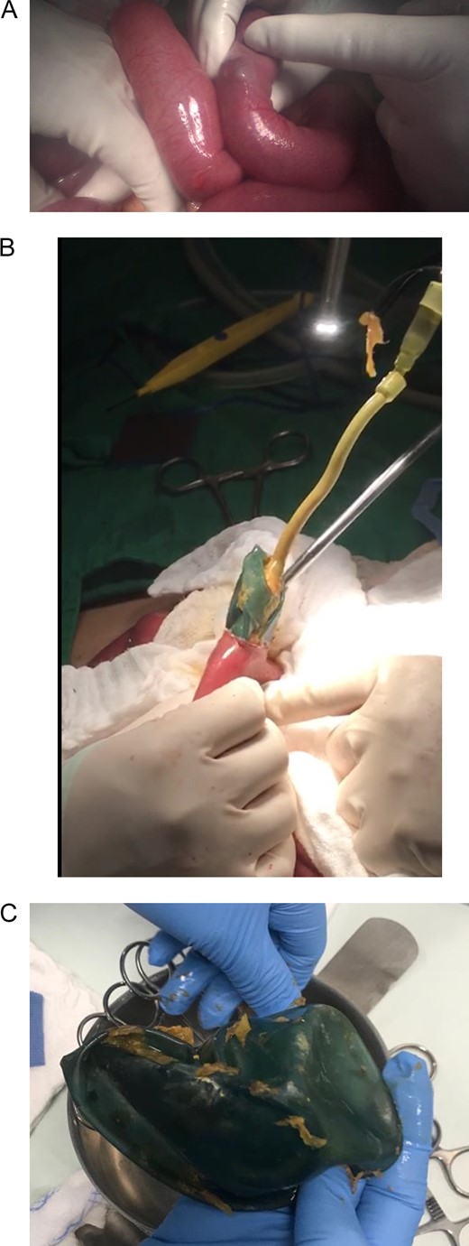 (A) Laparotomy, showing gastric balloon within the bowel. (B) Removal of the deflated gastric balloon. (C) Deflated gastric balloon.