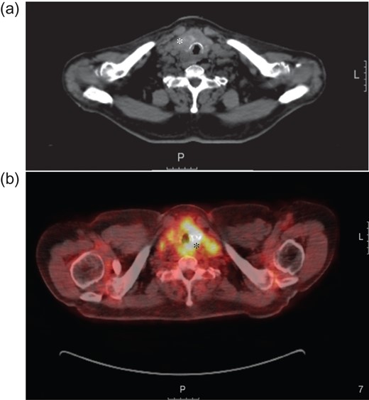 (a) Axial computed tomography image showing a thyroid mass (white asterisk) extending in to the trachea and invading the surrounding tissue. (b) Axial positron emission tomography (PET)/computer tomography image taken as part of the staging investigations, showing the thyroid mass with local invasion (black asterisk). L = Left.