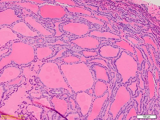 Medium power photomicrograph showing closely packed thyroid follicles containing thick colloid. The follicles are lined by elongated overlapping nuclei (H&E; ×20).