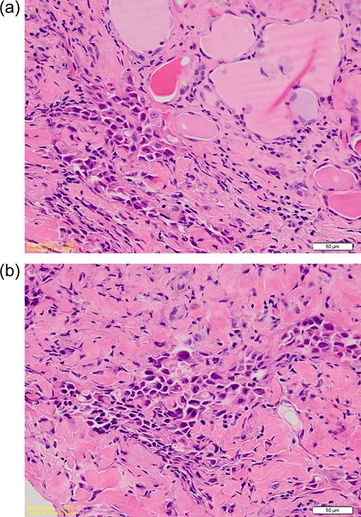 (a) High power photomicrograph showing overlapping nuclei with grooves and pseudoinclusions. (b) High power photomicrograph showing poorly differentiated tumour cells with hyperchromatic nuclei. Occasional intracytoplasmic lumina are seen. The features are consistent with a mucoepidermoid component. (H&E; ×40).