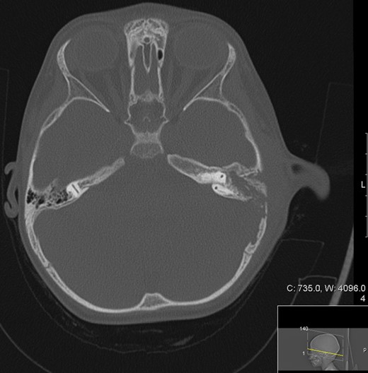 Transverse computed tomography (bone window) image showing a left sided mastoiditis (white asterisk) bone extensive cortical bony destruction involving left petrous, squamous and mastoid bone as well as the adjacent parietal bone.