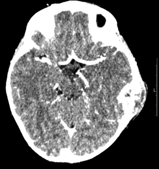 Transverse computer tomography with contrast (angiography), showing the extent of the extradural abscess (black asterisk). L = Left; R = Right. It shows that the left extracranial soft tissue abscess communicates freely through the parietal skull vault defect with the large intracranial extradural abscess, which spans the left tentorial leaflet.