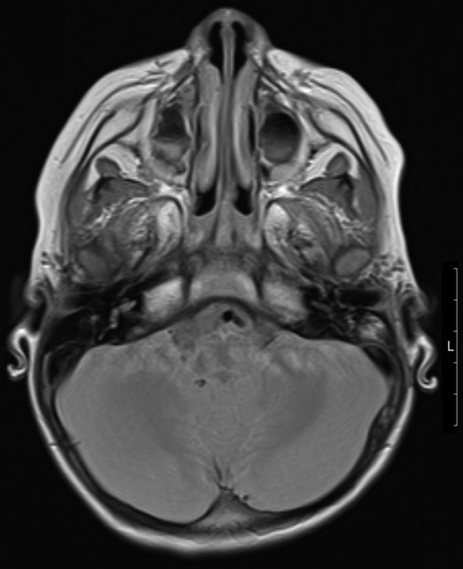Transverse magnetic resonance image 3 months post op showing some residual inflammation within the post-surgical mastoid cavity (white asterisk) and resolution of collection.