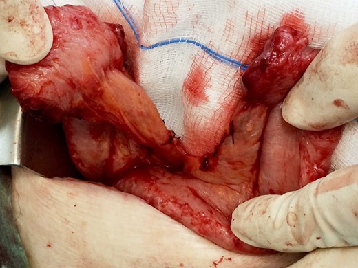 Division of a segment of jejunum and its mesentery, preserving the main blood supply.