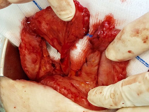 The divided segment of jejunum twisted 180° along its mesenteric axis.