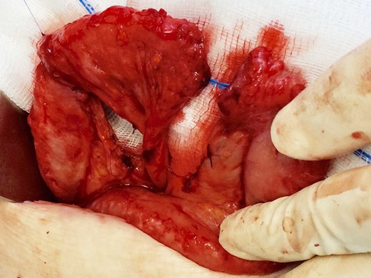 After ensuring adequate perfusion, proximal ends of the interposed jejunum were anastomosed.