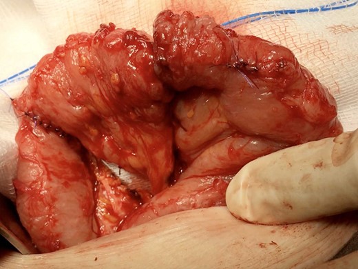 Completion of the jejunal interposition with closure of the mesentery with non-absorbable sutures.