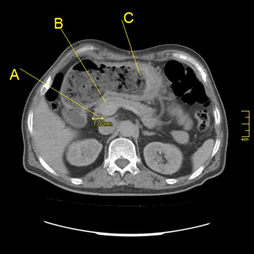 Abdominal computed tomography scan (axial section) showing: (A) Dilatation of common bile duct (a diameter of 13.7 mm). (B) Normal head of pancreas. (C) Thickening of greater curvature with a high amount of residual food.