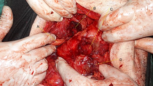 (A) Body of pancreas. (B) Perforated ulcer (3 by 3 cm) in the lower half of the posterior wall of the greater curvature with clear fibrosis. (C) A perforation (3 by 3 cm) in the top of the fourth portion of the duodenum. (D) Mesentery of transverse colon.
