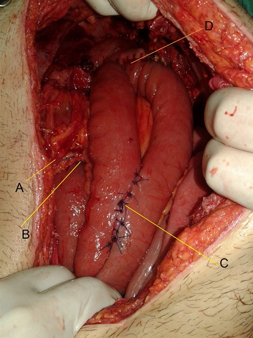 (A) Superior mesenteric vessels. (B) End to end third duodenojejunostomy. (C) Braun anastomosis. (D) Gastrojejunostomy.