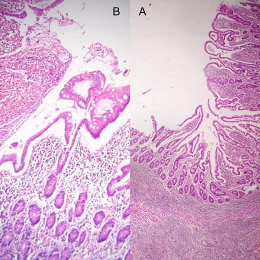 Both of (A) biopsy from the fourth duodenal segment and (B) biopsy from the greater curvature of stomach reveal a perforated benign gastric ulcer.