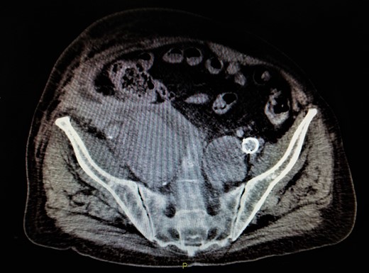 Contrast-enhanced CT depicted an increase of right IIA to 8,8 cm with type II endoleak from two runoff vessels deep in the pelvic cavity.