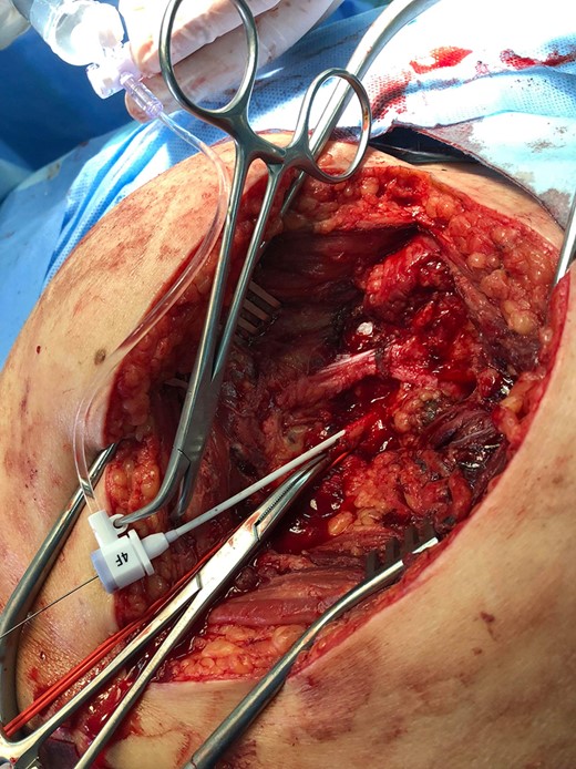 Posterior surgical access to the aneurysm, a sheath is inserted in the inferior gluteal artery.