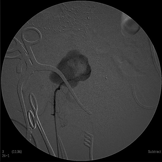 Intraoperative angiogram showing the presence of the aneurysm and two collateral vessels, embolization with coils of the sac and two feeding arteries. Completion angiogram depicted absence of blood flow in the IIA aneurysm and the runoff arteries.