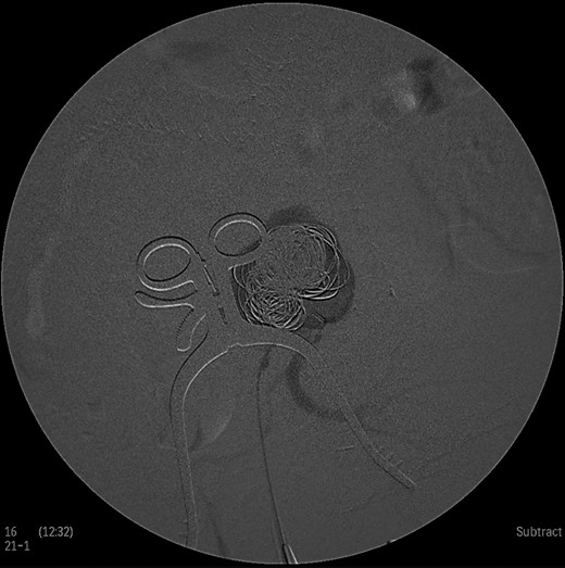 Intraoperative angiogram showing the presence of the aneurysm and two collateral vessels, embolization with coils of the sac and two feeding arteries. Completion angiogram depicted absence of blood flow in the IIA aneurysm and the runoff arteries.