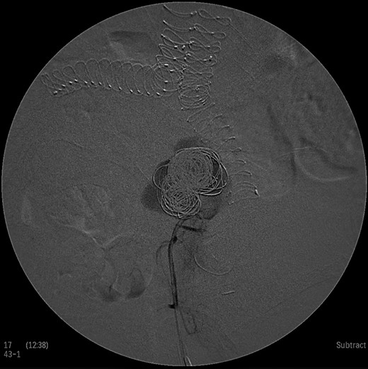 Intraoperative angiogram showing the presence of the aneurysm and two collateral vessels, embolization with coils of the sac and two feeding arteries. Completion angiogram depicted absence of blood flow in the IIA aneurysm and the runoff arteries.