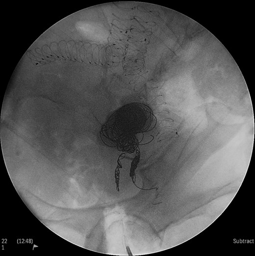 Intraoperative angiogram showing the presence of the aneurysm and two collateral vessels, embolization with coils of the sac and two feeding arteries. Completion angiogram depicted absence of blood flow in the IIA aneurysm and the runoff arteries.