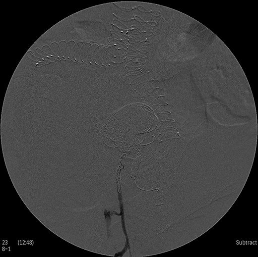 Intraoperative angiogram showing the presence of the aneurysm and two collateral vessels, embolization with coils of the sac and two feeding arteries. Completion angiogram depicted absence of blood flow in the IIA aneurysm and the runoff arteries.