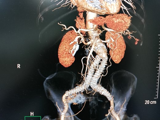 3D-CT aortography after 6 months depicted thrombosis of the aneurysm with coil embolization.
