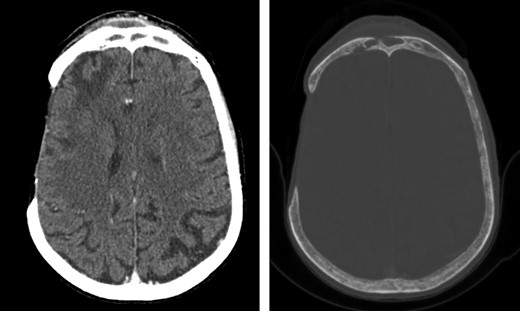 Axial computed tomography images of the head (left: brain window; right: bone window) showing a right-sided subperiosteal forehead collection and a right-sided extra-axial collection with underlying frontal lobe oedema, associated with erosion of the anterior and posterior wall of the right-sided frontal sinus. The images also show the previous right-sided temporal craniectomy defect with gliotic changes.