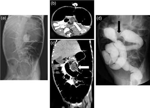 Radiologic findings from Case 1. (a) Abdominal X-ray films showing dilatation of bowel with gas. (b and c) Plain computed tomography showing suspected intestinal volvulus or intussusception (white arrow: suspected lesion). (d) Barium enema revealing an incomplete obstruction or stricture (black arrow: suspected lesion).