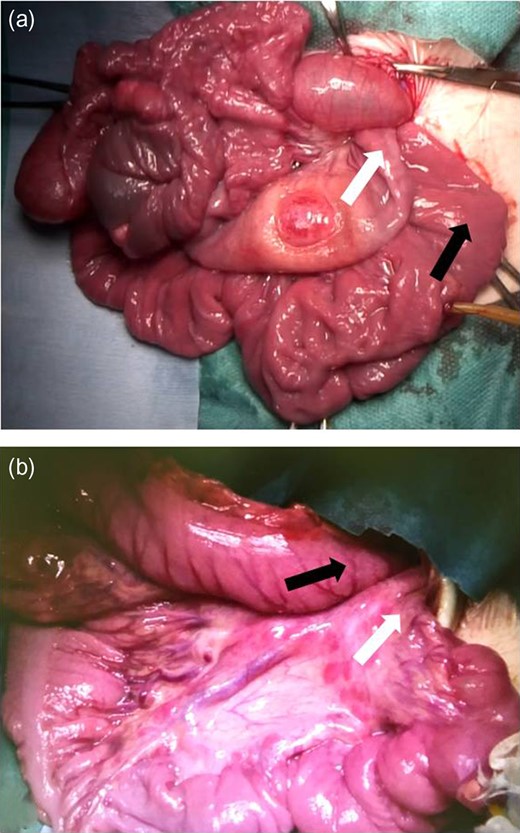Intra-operative findings from Case 1. (a and b) The findings before releasing the volvulus showing 180 degrees of counter-clockwise torsion and compression of the transverse colon by the intestine (white arrow: oral side, black arrow: anal side). Meckel’s diverticulum and multiple intestinal tumors suspected as ectopic pancreas are shown. The tube was inserted into the Meckel’s diverticulum to decompress the intestinal content.