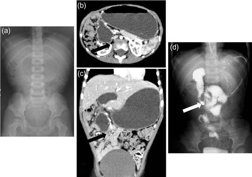 Radiologic findings from Case 2. (a) Abdominal X-ray films showing a gasless abdomen. (b and c) Enhanced CT showing a suspected duodenal obstruction (black arrow: suspected lesion). (d) Barium meal revealing malrotation and difficulty inserting the enteral feeding tube into the small intestine (white arrow: the tip of the tube).