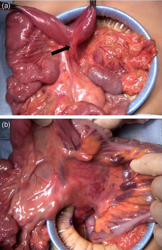 Intra-operative findings from Case 2. (a) The findings showing the abnormal bands tethering the duodenum, which caused extrinsic compression of the duodenum (black arrow: abnormal bands). (b) Mesenterium ileocolicum commune with malrotation of the intestine is shown.