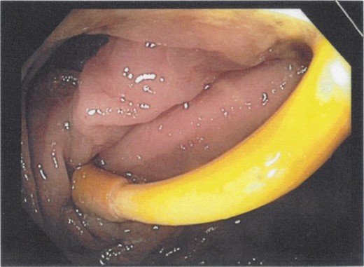 Tubular structure seen intraluminally during colonoscopy.