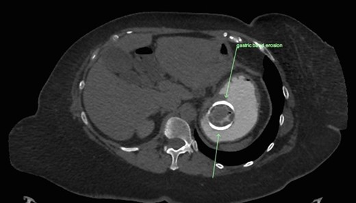 Gastric band erosion on axial view of CT abdomen.