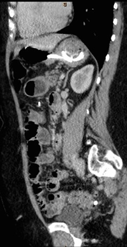 Sagittal view of CT abdomen showing the gastric band tubing eroding into posterior wall of transverse colon and exiting inferiorly.