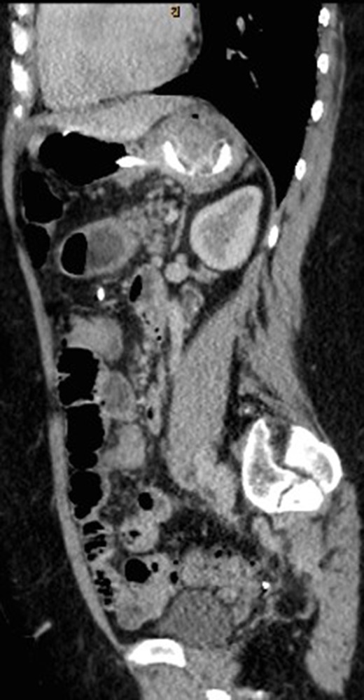 Sagittal view of CT abdomen showing the gastric band tubing eroding into posterior wall of transverse colon and exiting inferiorly.