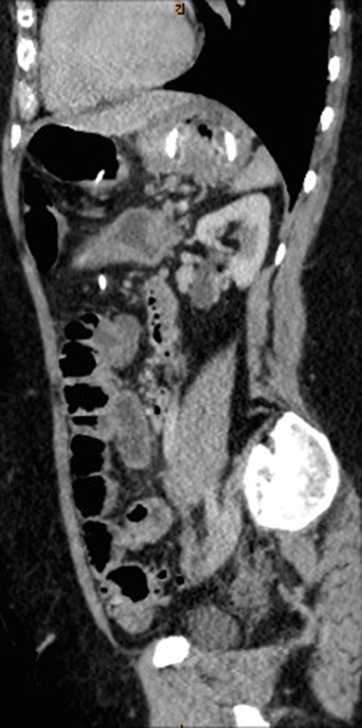 Sagittal view of CT abdomen showing the gastric band tubing eroding into posterior wall of transverse colon and exiting inferiorly.