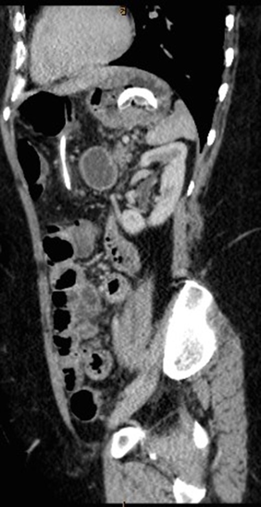 Sagittal view of CT abdomen showing the gastric band tubing eroding into posterior wall of transverse colon and exiting inferiorly.