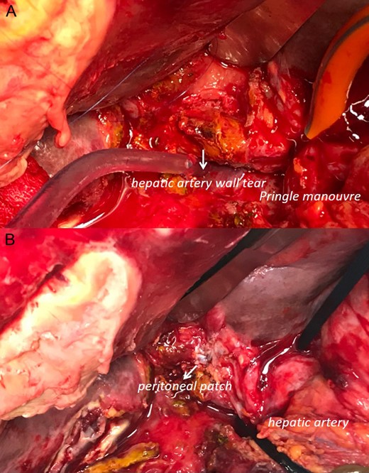 Intra-operative data (head up): (A) pringle maneuver and visualization of the hepatic artery wall tear. It is not possible to dissect or completely visualize the arteria wall. (B) declamping of the hepatic pedicle and visualization of reconstruction with peritoneum patch to sealing the artery tear.