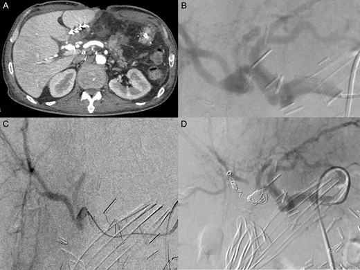 (A) CT scanner arterial phase: pseudoaneurysm of posterior branch of the right hepatic artery (11 mm Ø) (B) celiac angiography showed pseudoaneurysm in posterior branch of right hepatic artery (C) selected microcatheter 2.8 F was coaxially advanced to the pseudoaneurysm (D) selected embolization with five micro coils type Terumo (two 6 mm Ø; one 7 mm Ø; two 8 mm Ø).