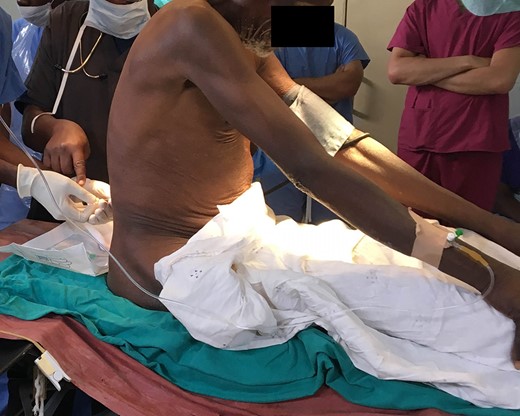 Eighty two-year-old man undergoing spinal anesthesia prior to surgical resection of penile mass.